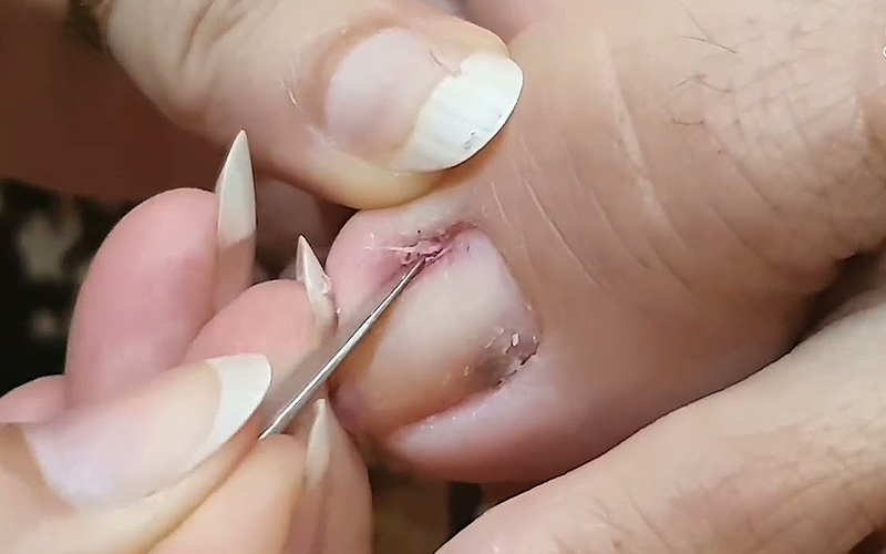 Lấy Khóe Móng Chân Có Thực Sự Cần Thiết? Những Điều Thợ Nail Và Khách Hàng Nên Biết