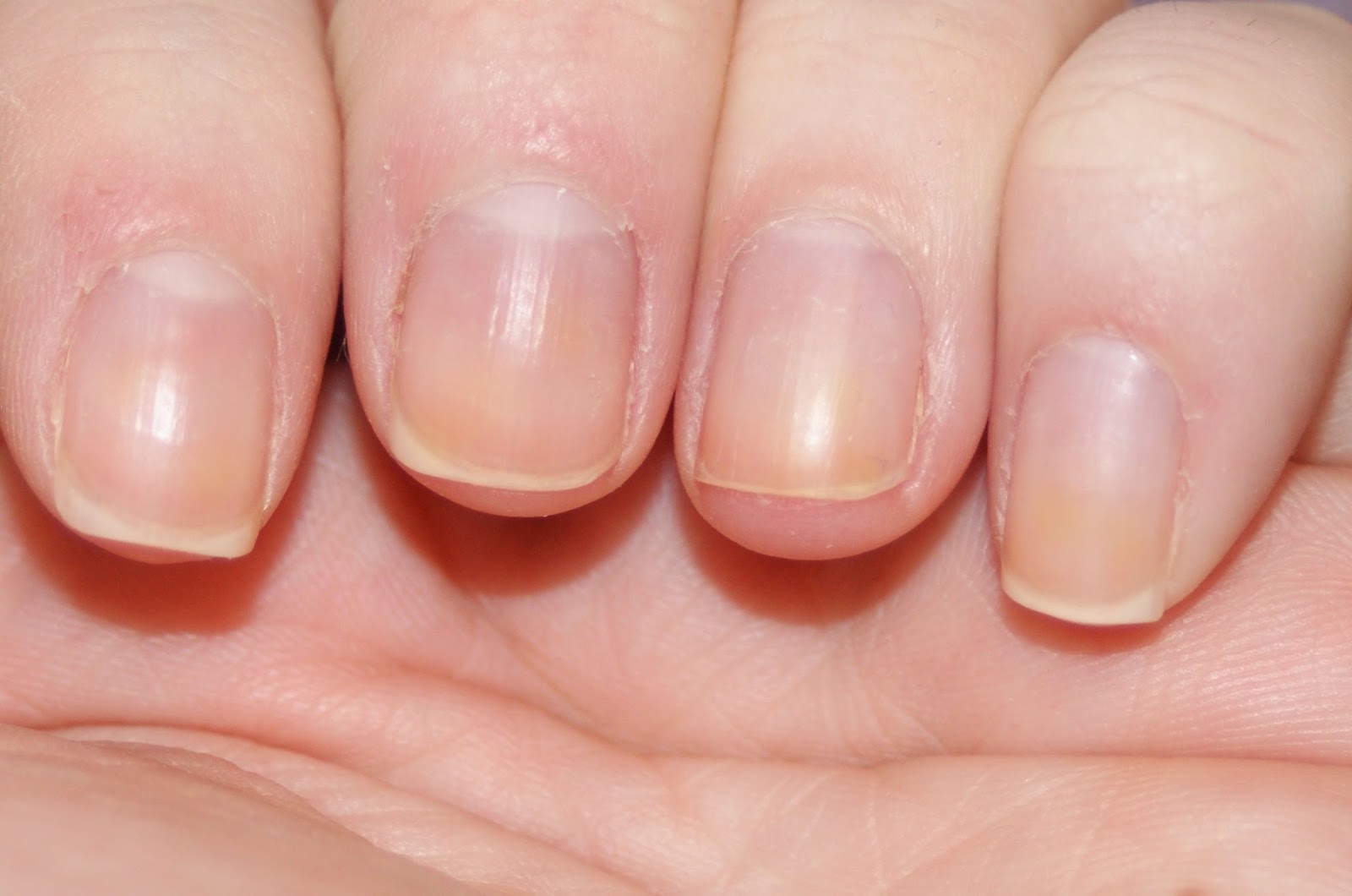 Vì Sao Làm Nail Xong Khách Bị Xước Da, Đau Rát Quanh Móng?