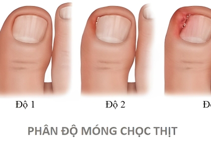 Móng chọc thịt – Viêm da quanh móng: Nguyên nhân, cách phòng và điều trị