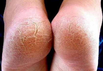 Gót chân khô nứt nẻ – câu chuyện nhỏ nhưng không hề nhỏ