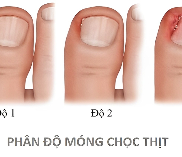 Móng chọc thịt – Viêm da quanh móng: Nguyên nhân, cách phòng và điều trị