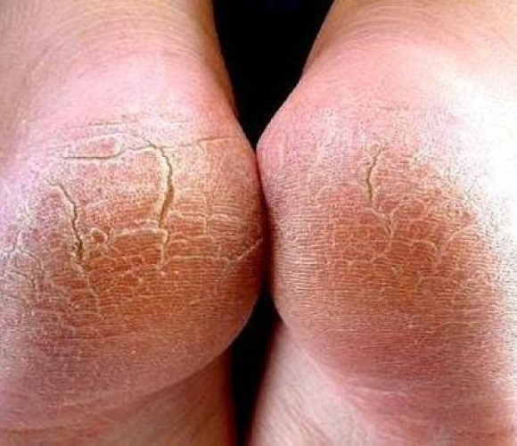 Gót chân khô nứt nẻ – câu chuyện nhỏ nhưng không hề nhỏ