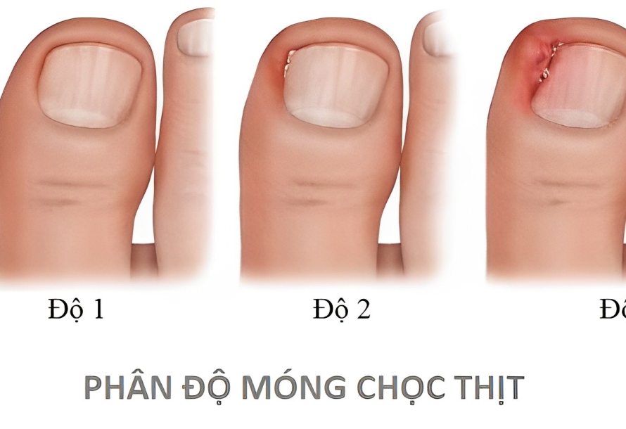 Móng chọc thịt – Viêm da quanh móng: Nguyên nhân, cách phòng và điều trị